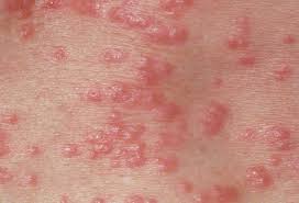 Allergic contact dermatitis is an allergic reaction that occurs after your skin comes into contact with an allergen (a substance that triggers this reaction). What 10 Common Skin Rashes Look Like