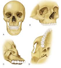 Maybe you would like to learn more about one of these? 16 Fractures Of The Zygomatic Complex And Arch Pocket Dentistry