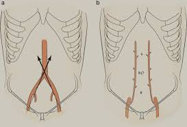 When umbilical entry is contraindicated we use the left upper quadrant or palmer's point. Principles Of Laparoscopic Surgery Sciencedirect