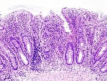 Ulcerative colitis or uc is chronic inflammatory disease of the large intestine (bowel) in which swelling and inflammation cause ulcers on the inner lining. Ulcerative Colitis Wikipedia