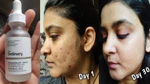 I can definitely say that after. How I Cleared My Acne Within 30 Days The Ordinary Niacinamide 10 Zinc 1 How To Get Rid Of Pimples Youtube