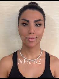 Micro Picasso Technique Micro SG and Stem Cell Nose repair- Correcting  facial asymmetry