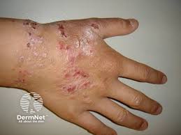 Image result for Atopic eczema atopic dermatitis