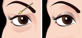 The Best Natural Way To Fix Drooping Or Sagging Eyelids Dusuk Gozler Kas Yaslanma