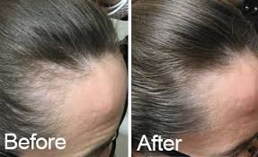 7 people found this helpful Vitamin E Capsules For Hair Growth Reviews