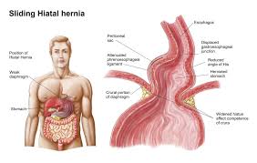 But a large hiatal hernia can allow food and acid to back up into your esophagus, leading to heartburn. Medical Ilustration Of A Hiatal Hernia In The Upper Part Of The Stomach Into The Thorax Poster Print Walmart Com Walmart Com