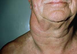 Non Hodgkin Lymphome Bluterkrankungen Msd Manual Ausgabe Fur Patienten