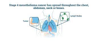 When diagnosed at stage 4, mesothelioma patients experience worsening symptoms. Stage 4 Mesothelioma Life Expectancy Palliative Treatments