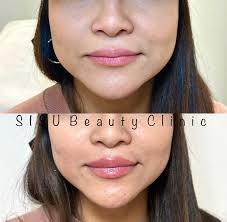 Half syringe of filler can add volume...