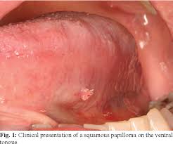 Image result for papillomavirus tongue)