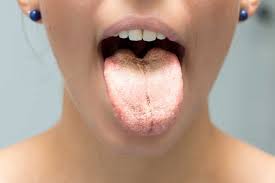 Soorosophagitis Ursachen Symptome Diagnose Und Behandlung Cara Care