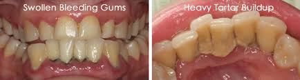 Hardened plaque in some cases hardened plaque attached to the gums can cause dark patches. Gum Disease Treatments Brisbane Windsor Dentists North Brisbane