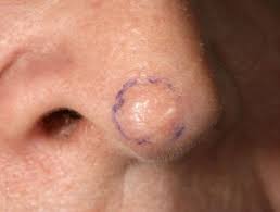 It can look like a: Basal Cell Carcinoma Affecting The Nose Images Dermnet Nz
