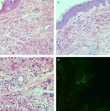 Vasculite leucocitoclástica após exposição à vacina para COVID‐19 | Anais  Brasileiros de Dermatologia (Portuguese)