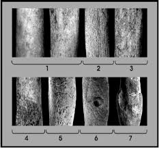 Image result for periostitis