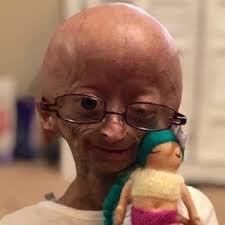 Adalia Rose Bio Wiki Age Death Parents Height Net Worth Progeria And Eyes