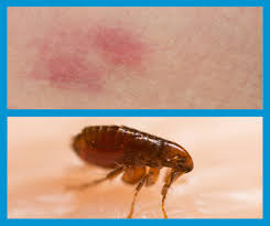 Les piqures de punaises de lit ressemblent aux piqures d'autres insectes, y compris celles de moustiques. Piqures Et Boutons De Punaise De Lit Comment Les Reconnaitre Traiter Et Soigner Les Boutons De Punaises De Lit