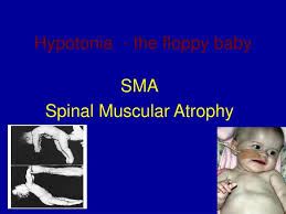 Image result for Floppy Infant