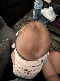 دور الأهل في الوقاية من تسطّح الرأس