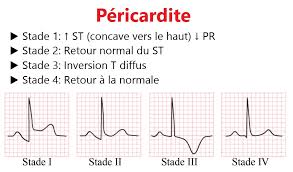 La péricardite est l'inflammation de la séreuse qui entoure le cœur  (péricarde) elle est classiquement associée à des modifications de l'ECG  qui évoluent en quatre étapes. <img crossOrigin=