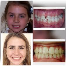 When i got insurance though work i got. Before After Braces Wazio Orthodontics