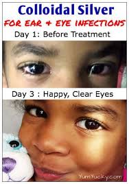 Pin On Home Remedies For Pink Eye