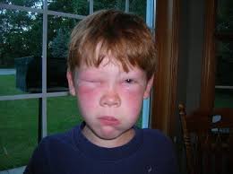 Bee Sting!. Stinging Pests: Facts, Identification &…