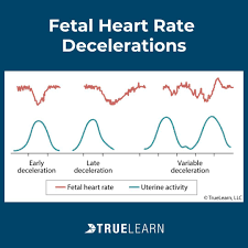 Image result for Early Deceleration