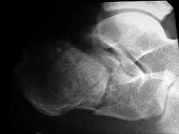 Image result for Calcaneus Compression Fracture