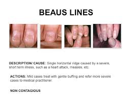 Nail Diseases Disorders Ppt Video Online Download