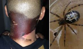 The species closely resembles the black widow spider, aside from its colouring. Pictured False Widow Spider Bite Turned My Neck Black Uk News Express Co Uk