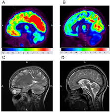 Pet scan is position emission tomography whereas ct scan is computed tomography. Differences In Fdg Uptake In Pet Ct Scans Of The Brain Between A Download Scientific Diagram