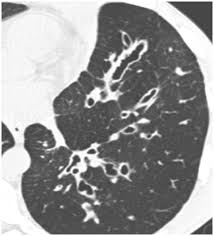 Emphysema is very different than lung cancer. Bronchiectasis Cancer Therapy Advisor