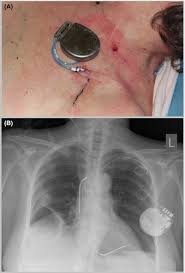 Английски думи, подобни на icd: Temporary External Implantable Cardioverter Defibrillator As A Bridge To Reimplantation After Infected Device Extraction Debski 2018 Journal Of Arrhythmia Wiley Online Library