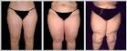 Effect of metformin on serum interleukin-levels in polycystic ovary