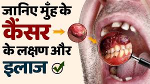 जानिए मुँह के कैंसर को जड़ से ठीक ...