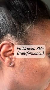 Ginny Hyperpigmentation