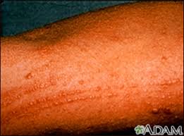 Image result for dermatitis contacta toxica