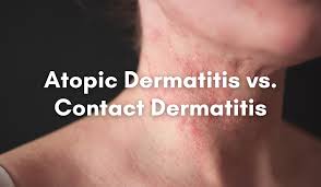 Image result for dermatitis contacta children