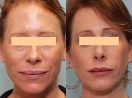 Laser Resurfacing Gallery