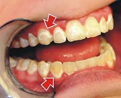 The consistent brushing of the metal against the teeth many times end up eroding parts of the enamel which is what resembles the white. How Do You Treat White Spots After Braces Ask An Orthodontist Com