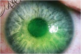 A controlled trial of oral acyclovir for the prevention of stromal keratitis or iritis in patients with herpes simplex virus epithelial keratitis. Herpes Simplex Epithelial Keratitis Associated With Daily Disposable Contact Lens Wear Sciencedirect