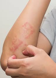 Image result for Atopic eczema atopic dermatitis