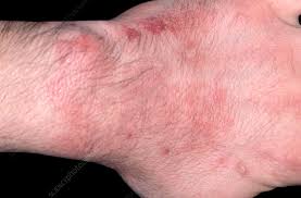 Image result for Erysipeloid