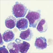 It's highest if you're over age 65. Engineered Bone Marrow Cells Slow Growth Of Prostate And Pancreatic Cancer Cells Eurekalert Science News
