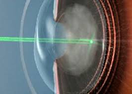 Augenarzt Reinickendorf Yag Laser