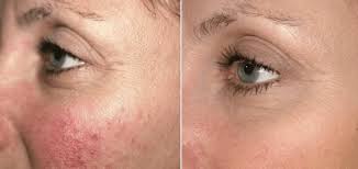 En extremt kraftig allergisk reaktion med hudutslag vanligen i form av blåsor eller sår i munhåla och ögon, samt andra slemhinnor som till exempel könsorgan Rosacea Varfor Far Jag Och Hur Behandlar Jag