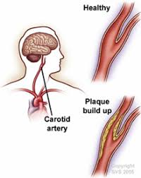 These arteries arise in the neck, and ascend to the cranium. Carotid Artery Disease Oregon Surgical Specialists