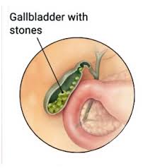 Functional gallbladder disorder is being diagnosed more often in the office setting, increasing the number of cholecystectomies performed over the past two decades. Biblical Discipline Surviving God S Woodshed