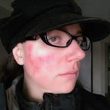 Baxt likes neutrogena products for those dealing with rosacea. Why I Ll Gladly Use Led Light Therapy For Rosacea For The Rest Of My Life Talkhealth Blogtalkhealth Blog